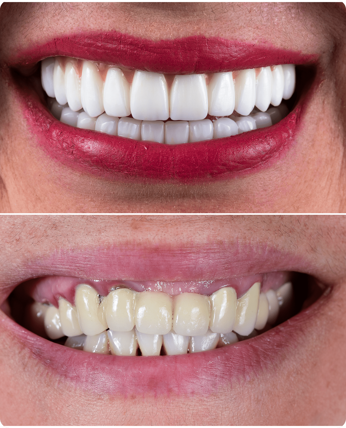 Teeth whitening before and after comparison.