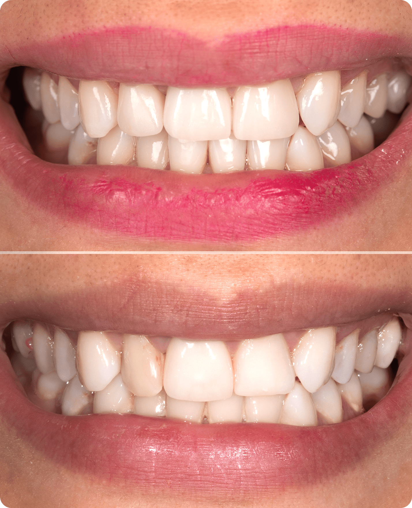 Before and after teeth whitening comparison.