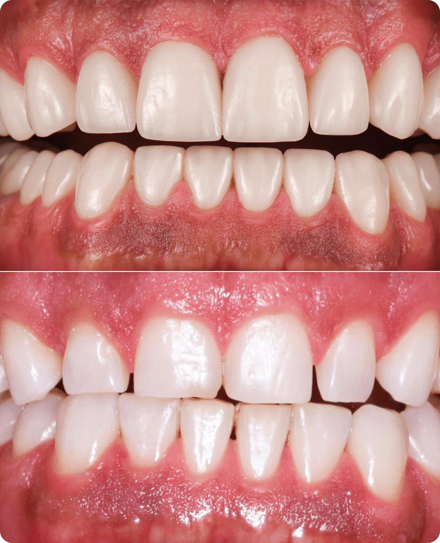 Dental before and after comparison photo.
