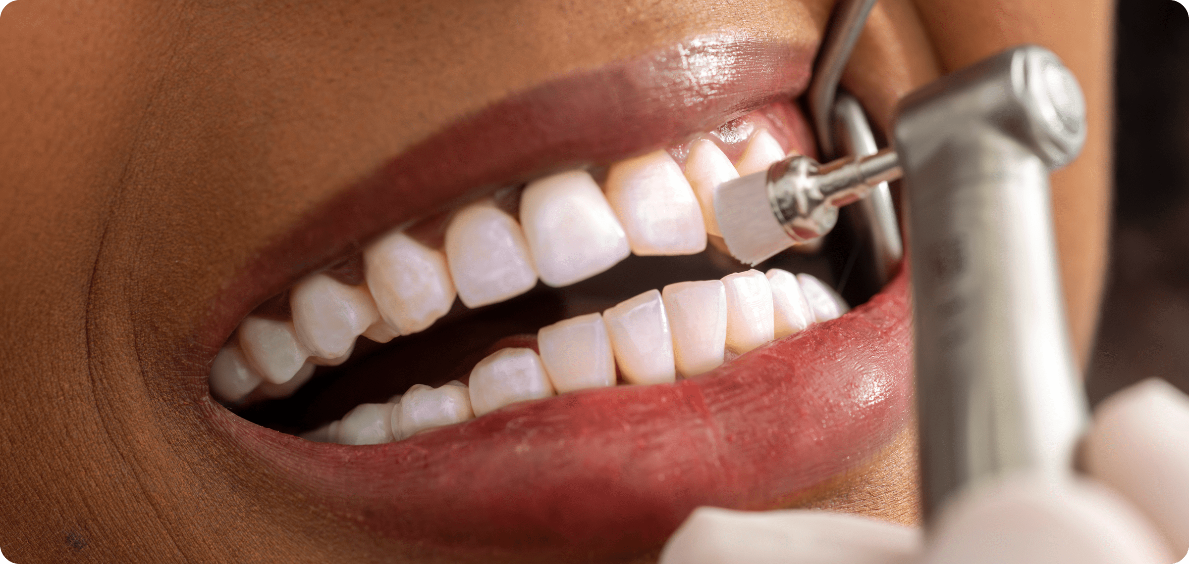 Teeth cleaning procedure at dental clinic.