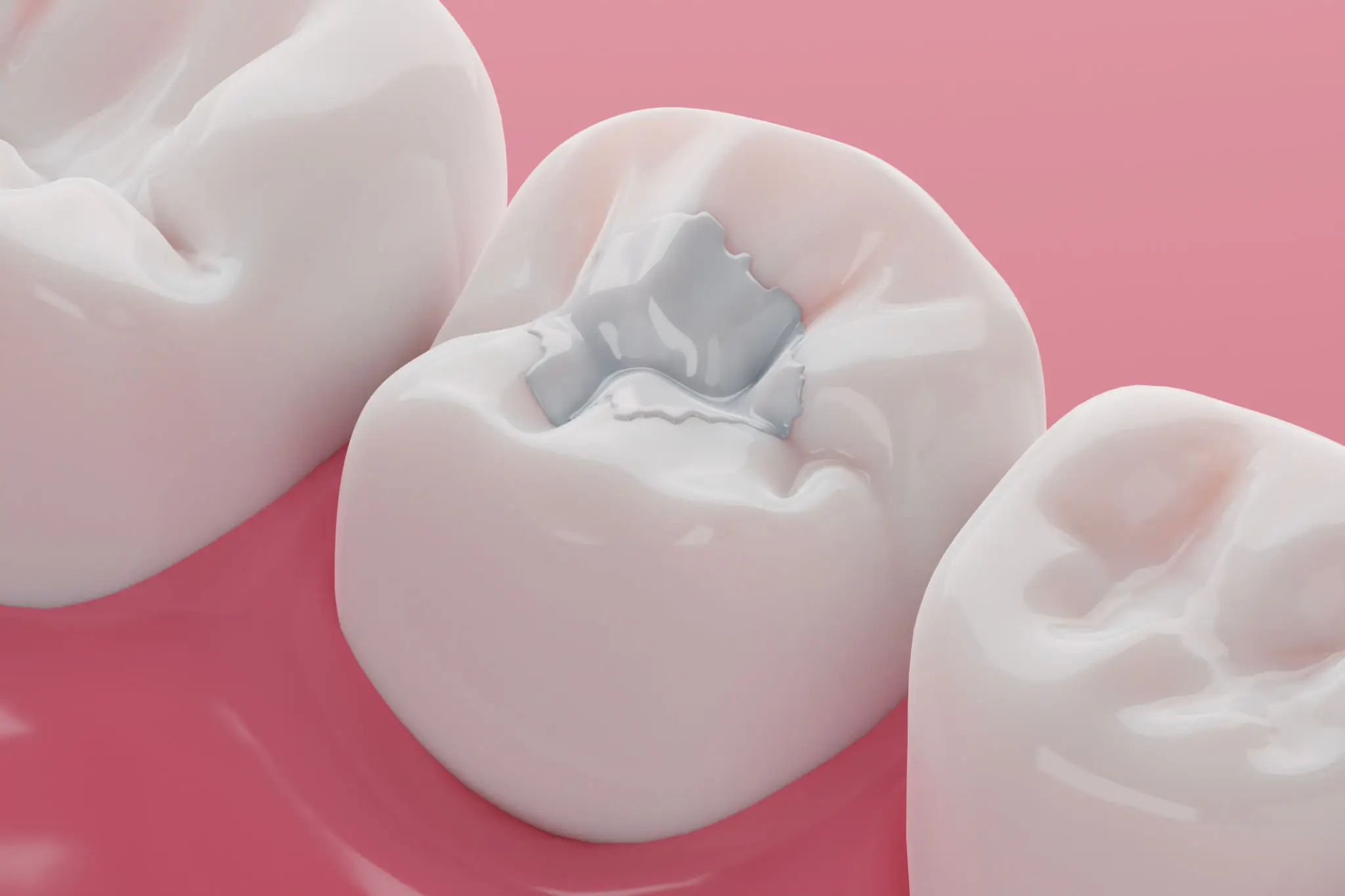 Close-up of a molar tooth with a dental filling.