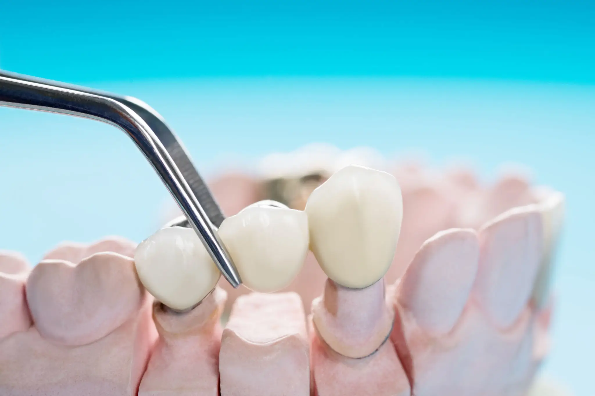 Dental tool placing a crown on a tooth model.