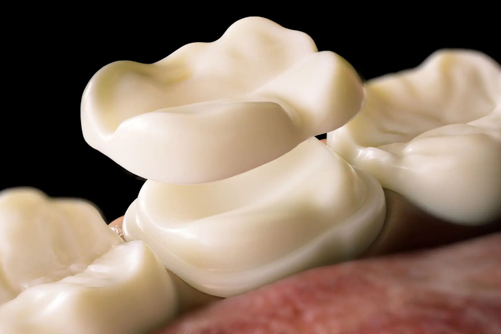Close-up of dental crown restorations on molar teeth.