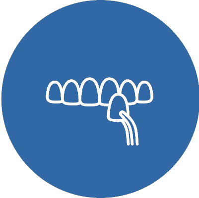 Non-Prepped Veneers